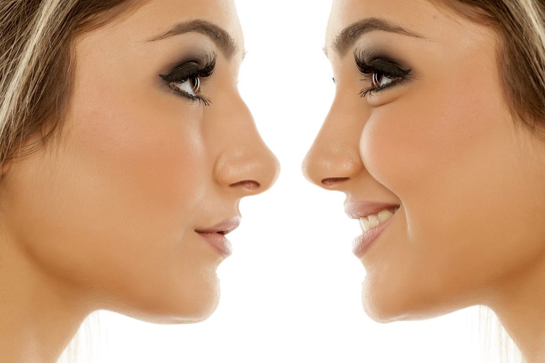 From Crooked to Confident: 10 Reasons to Get Rhinoplasty