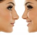 From Crooked to Confident: 10 Reasons to Get Rhinoplasty