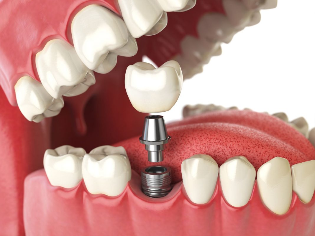 4 Reasons Why Dental Implants are Right For You