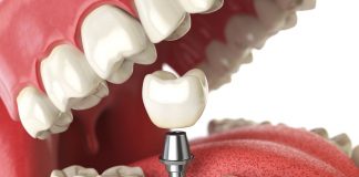 4 Reasons Why Dental Implants are Right For You