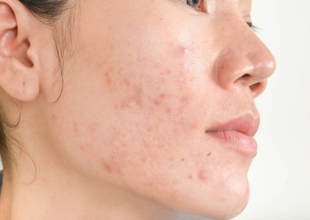 Do You Really Need Professional Help With Acne?