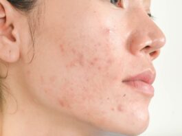 Do You Really Need Professional Help With Acne?