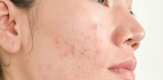 Do You Really Need Professional Help With Acne?