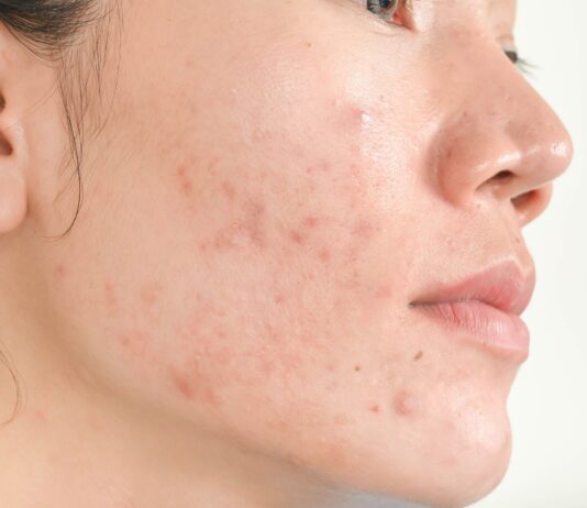 Do You Really Need Professional Help With Acne?