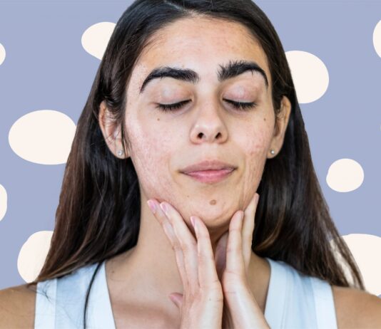 Skincare Tips to Help Reduce Your Acne